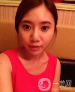 去颊脂垫果图赏析 没有就没有伤害