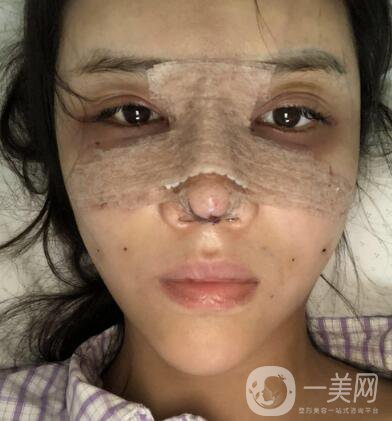 上海华美李健面部脂肪填充+隆鼻三个月