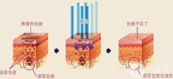 激光祛痘注意事项有哪些？