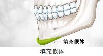 硅胶垫下巴要疼几天？如何缓解这种疼痛感？