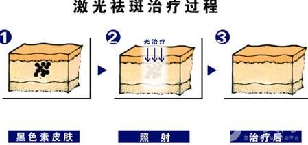 激光祛斑的优势有哪些?为什么这么多人去做?