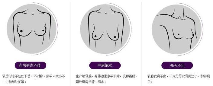 假体隆胸具体有哪些方法?材料不同方法不同?