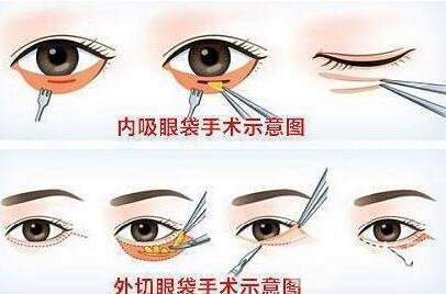 解答：不手术去眼袋的方法有没有?是商家噱头吗?