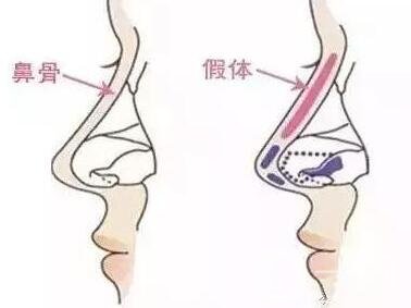假体隆鼻的前后照片 这差距也太大了吧~
