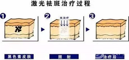 激光去雀斑会反弹吗?术后注意事项有哪些?