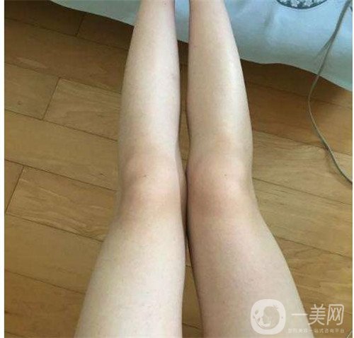 激光溶脂瘦大腿疼吗？可以忍受吗？