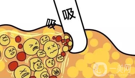 吸脂减肥怎么样?塑形*果好吗?