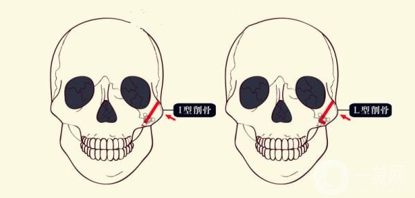 颧骨内推和磨骨有什么区别？哪个效果更好？