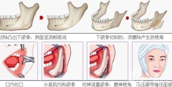 宽下颌角整形手术原来是这样做的!【解析】