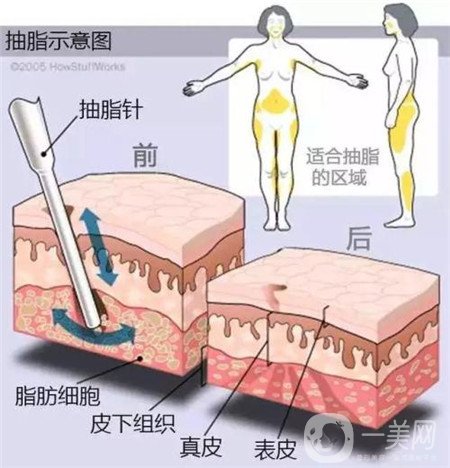 局部吸脂痛苦吗?多久可以恢复呢?