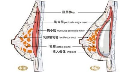 曼托假体和麦格假体哪种手感更好？教你怎么选择？