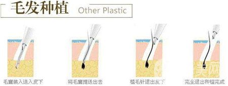 毛发种植费用大概要多少钱？