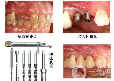 湖州种植牙多少钱 
