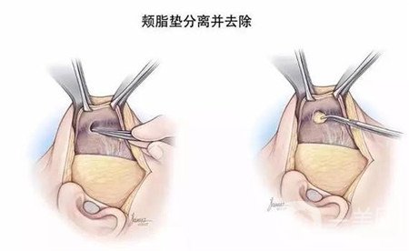 去颊脂垫几天消肿?多久才能正常吃饭?