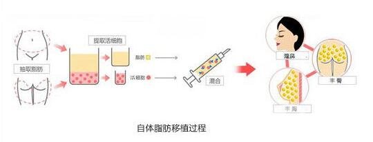 自体脂肪隆鼻术前准备你必须要知道!