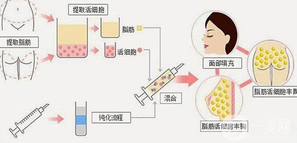 自体脂肪填充的价格是怎么计费的?