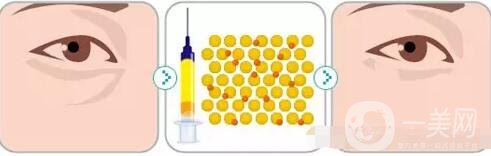 自体脂肪填充泪沟恢复过程图片展示