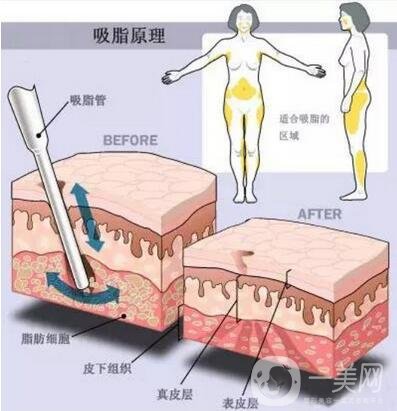 腰腹部吸脂后多久消肿?要多久才不肿?