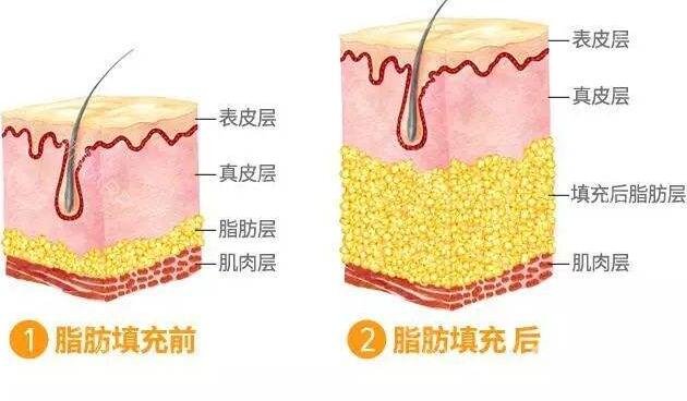 成都自体脂肪填充医院有哪些?