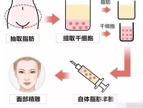 自体脂肪填充副作用及后遗症是什么?