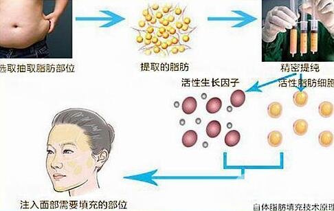 自体脂肪填充介绍?全国哪些机构做得好?