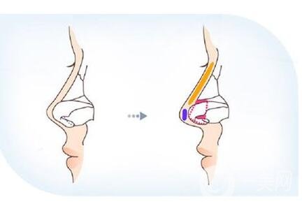 鼻小柱太长怎么缩短?方法介绍