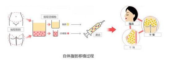 自体脂肪隆鼻缺点是什么?小白必知