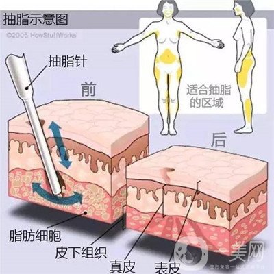 腰腹环吸后要肿多长时间呢？可以活动吗？