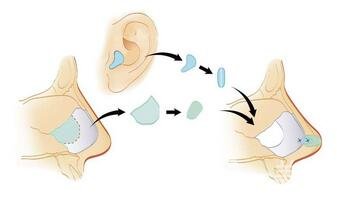 自体软骨隆鼻整形疼吗？*吗？