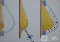 自体脂肪填充丰胸的价格要多少钱?