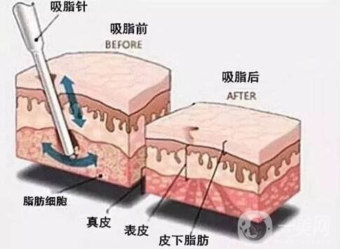 大腿吸脂第五天开始爆肿是医生打肿胀液的缘故吗?