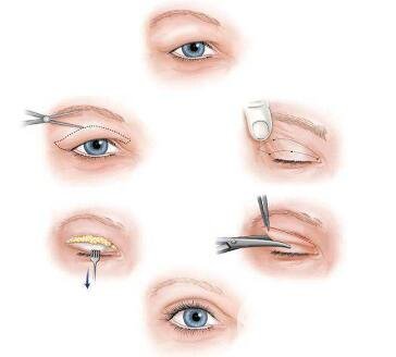 割双眼皮过程大概需要多长时间?