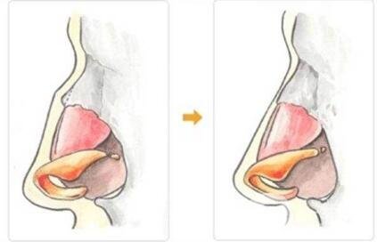 歪鼻矫正手术