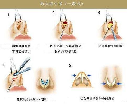 鼻头肥大缩小术是持久*的吗？