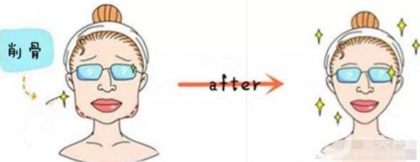 女人后缩下颌角整形变化有多大?