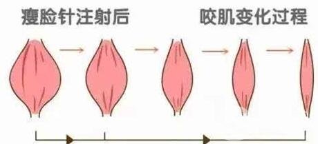 咬肌切除手术和*信息介绍些?