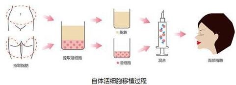 自身脂肪填充面部多久恢复?手术之后要注意?