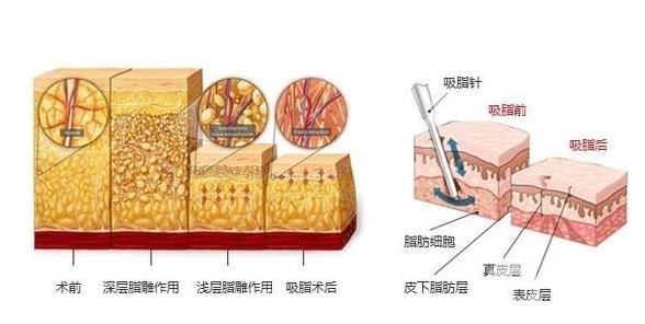 360度吸脂的手术需要多少钱？