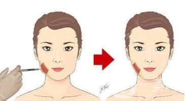 注射美容术可以改良脸部哪些情况？