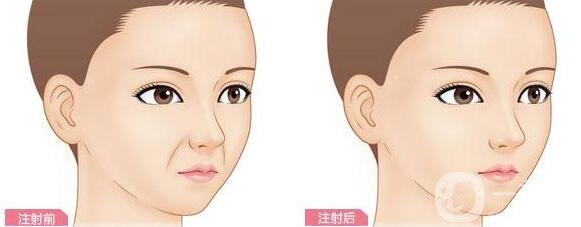 玻尿酸丰鼻唇沟能维持多长时间?