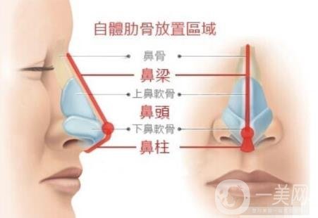 韩式肋骨隆鼻手术多少钱？*果怎样？
