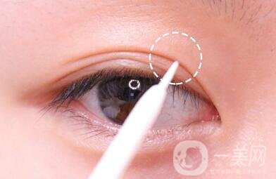 三点定位双眼皮手术后应该注意些什么？