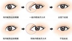 开内眼角恢复过程中需要注意哪些事项?