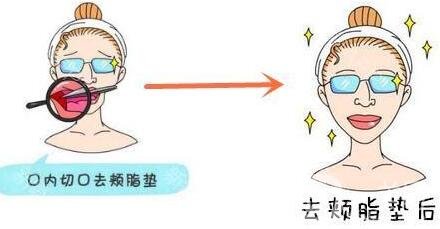 去颊脂垫价格贵不贵?收费情况说明