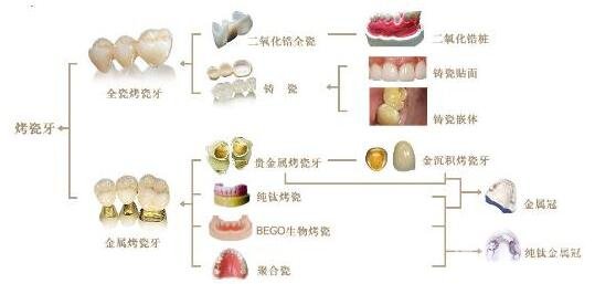 烤瓷牙的种类有哪些?哪种比较好?