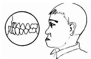 双颌前突带牙套可以矫正吗？