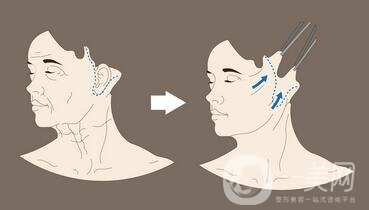 颈部除皱提升术要多少钱？贵不贵？