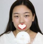 西南医院整形美容外科价格表，附双眼皮手术果一览