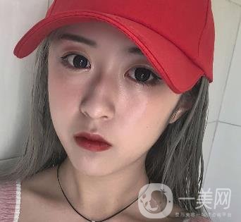 西安叶子整形美容医院双眼皮