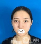 广州禾丽医院做双眼皮怎么样?看果图和价格表